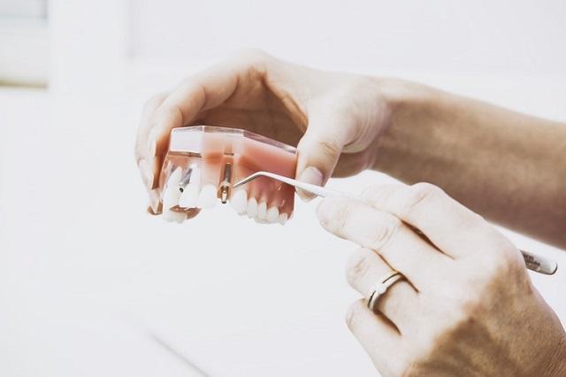 имплантация зубов в туле