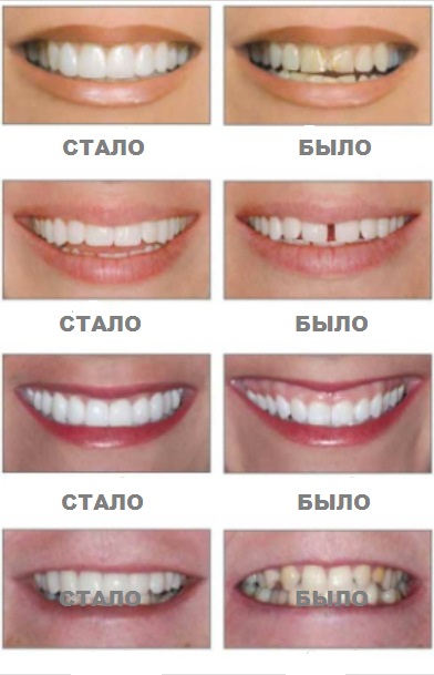 установить виниры, изменить цвет зубной эмали, реставрация зубов, восстановление зубов